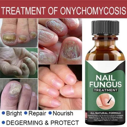 Fast Nail Fungal Treatments Nail Repair Essences Serum Care Treatments Foot Nail Fungus Removal Ge