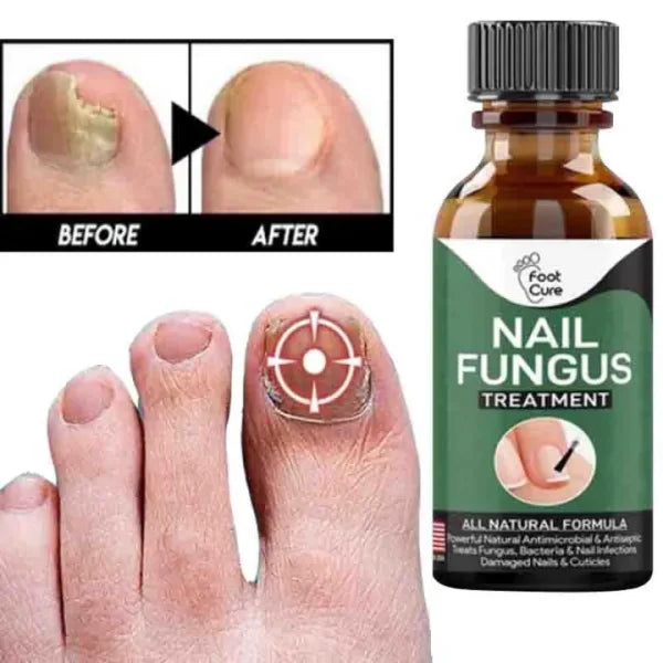 Fast Nail Fungal Treatments Nail Repair Essences Serum Care Treatments Foot Nail Fungus Removal Ge