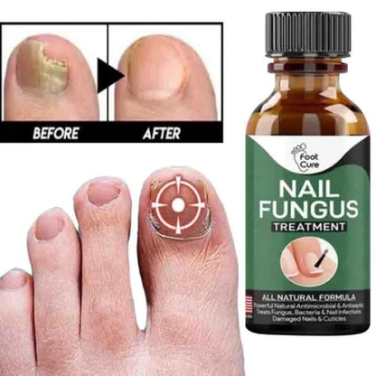 Fast Nail Fungal Treatments Nail Repair Essences Serum Care Treatments Foot Nail Fungus Removal Ge