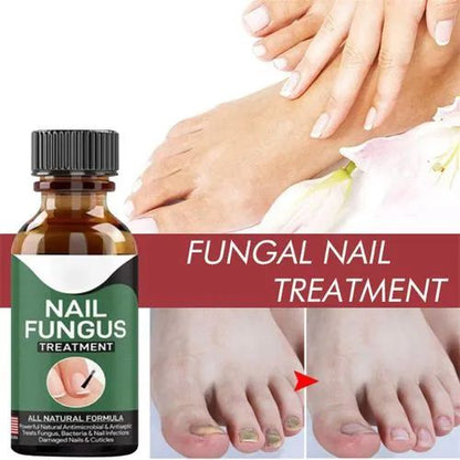 Fast Nail Fungal Treatments Nail Repair Essences Serum Care Treatments Foot Nail Fungus Removal Ge